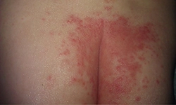 سوختگی در محل کهنه نوزاد