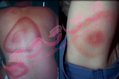 بیماری لایم