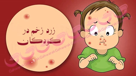 علائم، درمان و روش پیشگیری از بیماری زرد زخم در کودکان