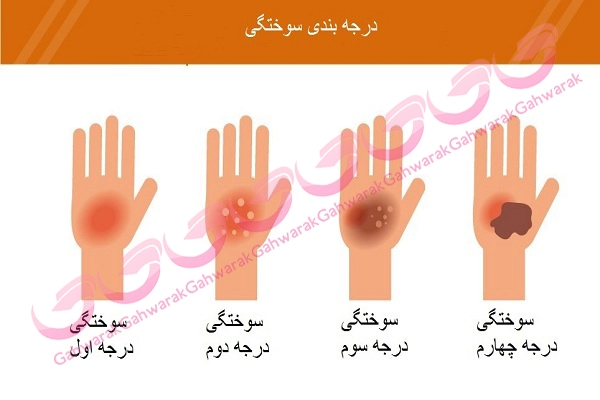 درمان خانگی سوختگی