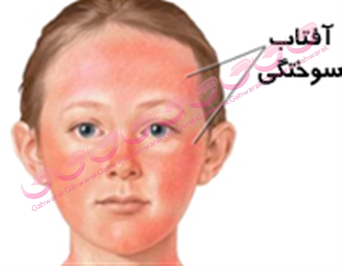 آفتاب سوختگي