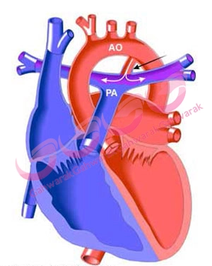 مجراي شرياني باز