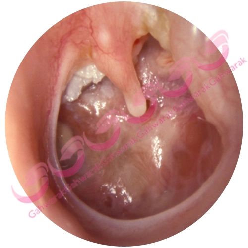 چسب گوش چیست ؟