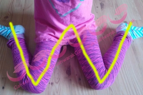 وضعیت های ممنوع برای نشستن کودکان در وضعیت W