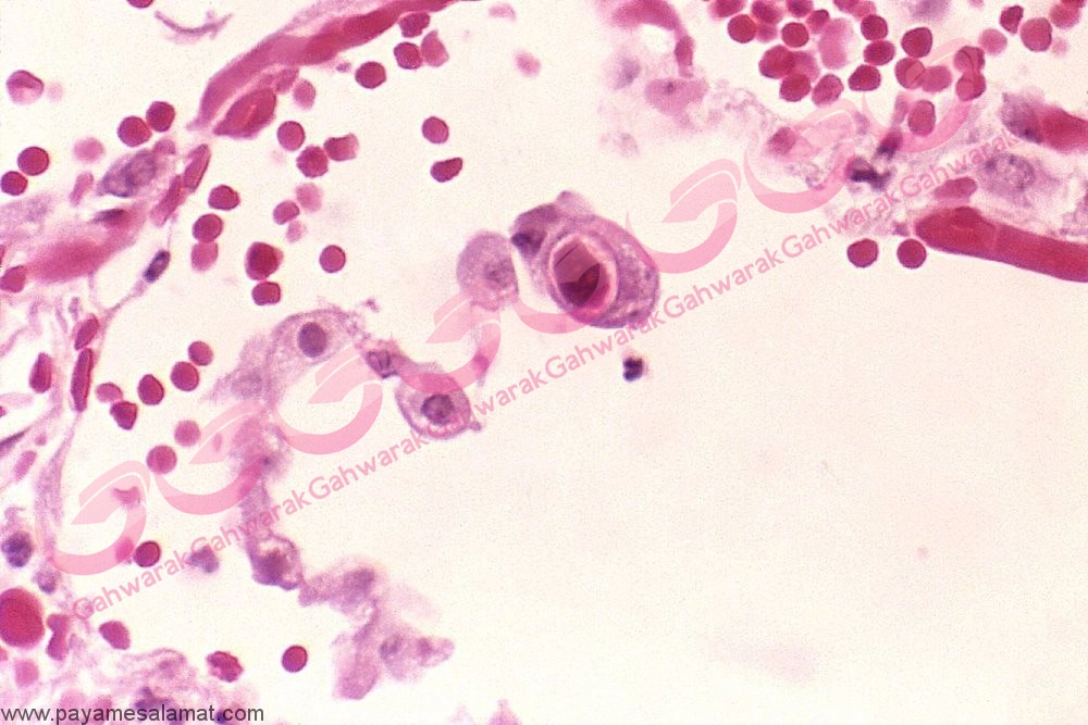 عفونت سیتومگاو ویروس