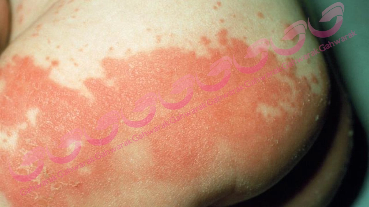 راش پوشک بچه