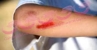 درمان بريدگي و خراش كودكان