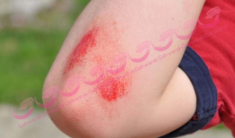 درمان بريدگي و خراش كودكان