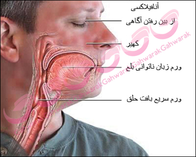 شوك آنافيلاكتيك