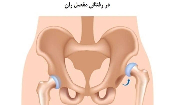 در رفتگی مفصل ران