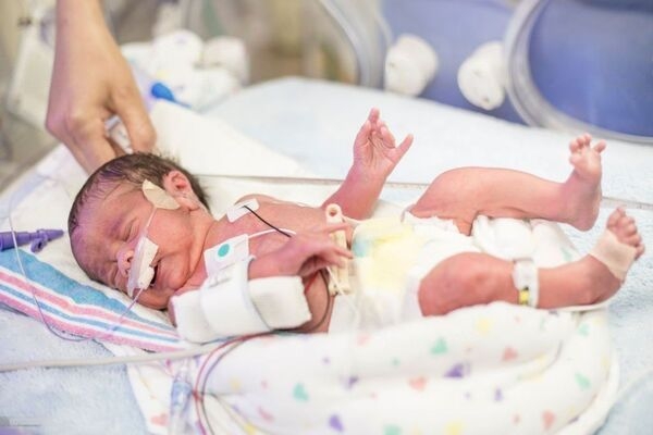 آزمایشات نوزادان نارس در nicu