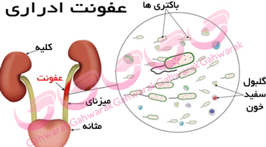 عفونت ادراری 