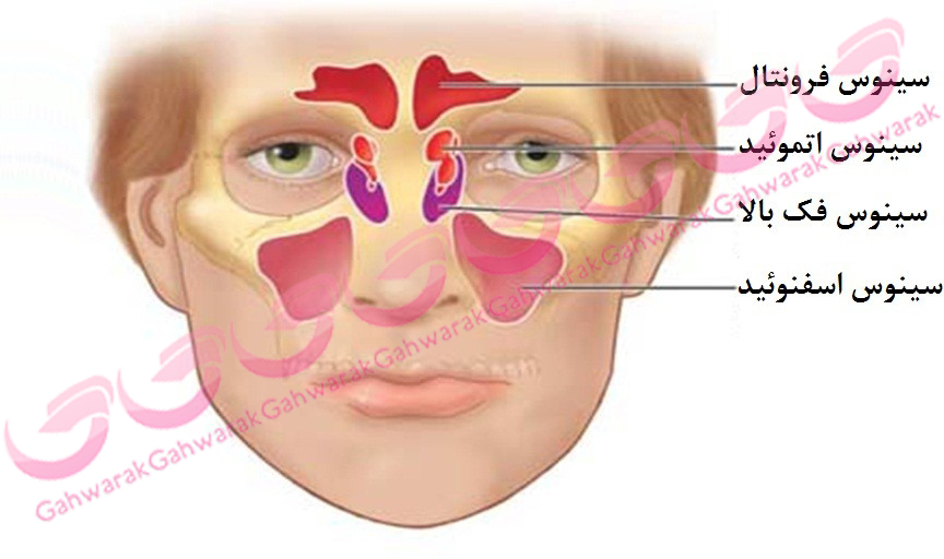 سینوزیت چیست (عوامل+ علائم + درمان )