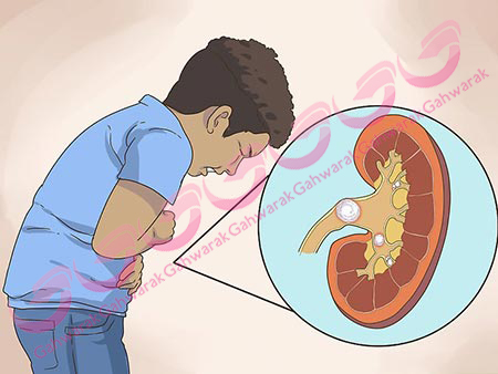 علت شیوع سنگ کلیه کودکان + روش های درمانی