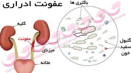 عفونت مجاری ادراری در کودکان 