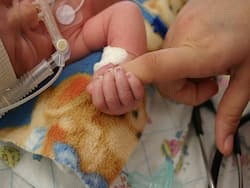 سندرم تنفسی RDS در نوزادان نارس 
