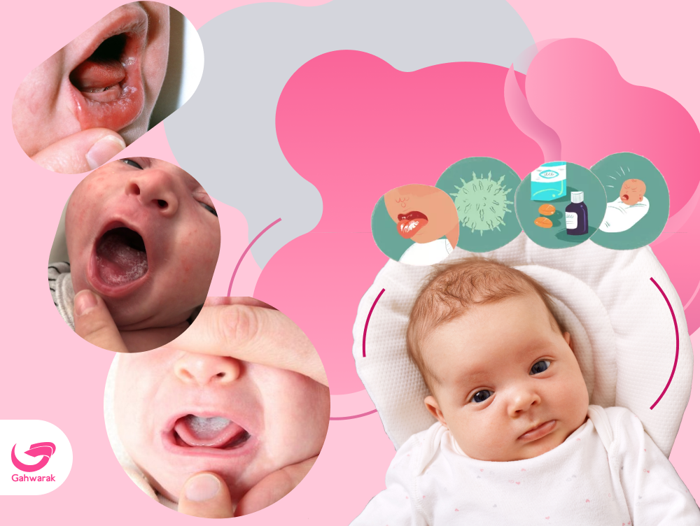 برفک دهان نوزاد چیست؟علائم و درمان آن