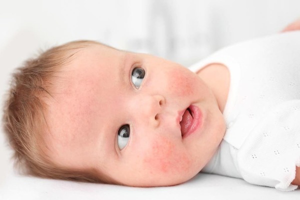 آلرژی به گندم در کودکان چیست؟(علایم، درمان)