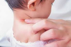 بثورات گردن نوزاد چیست؟ علائم، علل و درمان