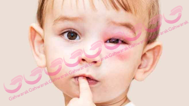 عفونت چشمی در کودکان 