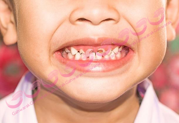 عوامل پوسیدگی دندان در کودکان 