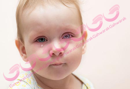 آبریزش چشم نوزاد، چه عللی دارد؟ 