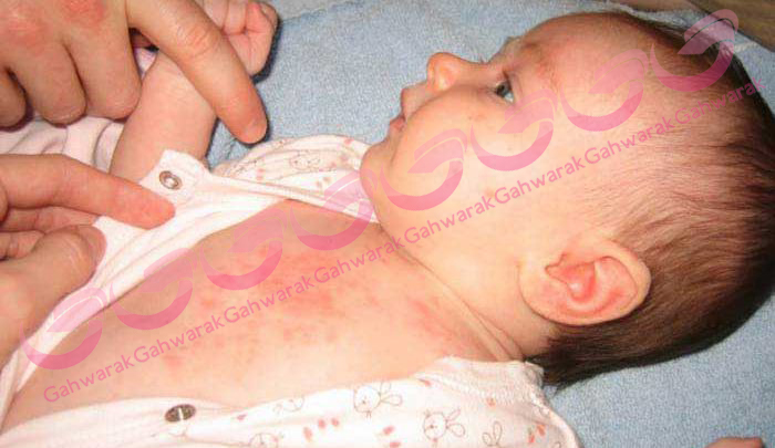 آلرژی نوزادی چیست؟ 