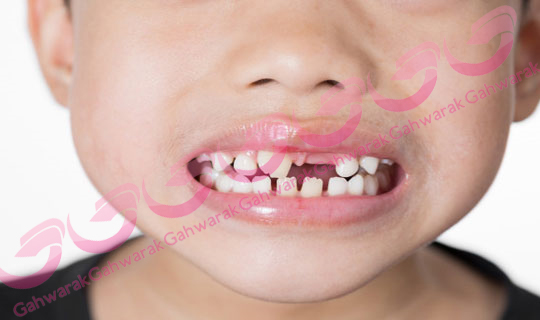 جلوگیری از بهم ریختگی دندان فرزندان