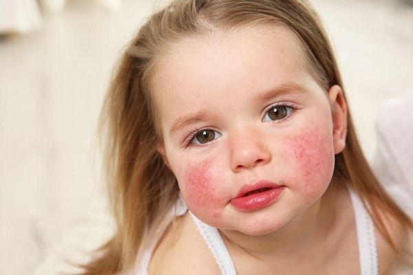 آلرژی به گندم در کودکان